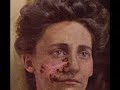 rotting skin disease rotting skin disease