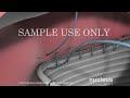 If you like this animation, LIKE us on Facebook: www.nucleusinc.com www.nucleusinc.com This 3D animation on abdominal aortic aneurysm surgery depicts the anatomy of the aorta and both the open and endovascular procedure for repairing an abdominal aortic aneurysm. Abdominal aortic aneurysm (also known as AAA, pronounced 