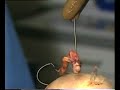 ACL Reconstruction all-inside Part2