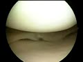 cirugia artroscopica rotura meniscal rotula