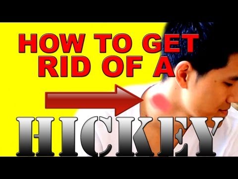 how to get rid rid of a hickey