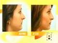 Dr. Lam discusses Rhinoplasty 
