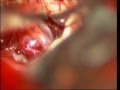 Brain aneurysm anterior communicating artery (ACOMA)-microsurgery-dr suresh dugani/HUBLI/INDIA