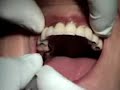 Full upper teeth replacement