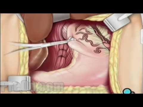 how to fasten muscle repair