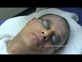 Laser Skin Resurfacing for Acne Scars