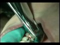Extraction of tooth #30 with cowhorn and elevator Extraction of tooth #30 with cowhorn and elevator