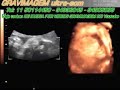 GRAVIMAGEM 53 (ULTRA-SOM GRAVIDEZ 3D 4D 30 SEMANAS) GRAVIMAGEM 53 (ULTRA-SOM GRAVIDEZ 3D 4D 30 SEMANAS)