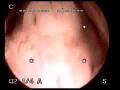 Medical - Cystoscopy