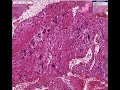 Histopathology Uterus--Syncytial endometritis Histopathology Uterus--Syncytial endometritis