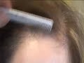Dr Ray Woods: Female Hair Transplant Dr Ray Woods: Female Hair Transplant