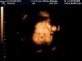 Twins at 28 weeks, 3D ultrasound in color, part 3