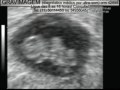 GRAVIMAGEM 282 (ultra-som trans-vaginal do primeiro trimestre da gravidez)