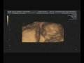 Baby Sacco 17 weeks