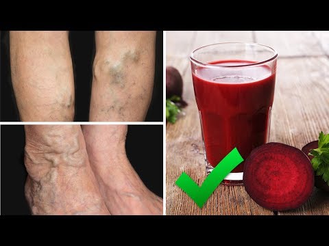 Drink This Juice To Prevent and Treat Varicose Veins