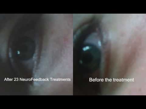 how to treat nystagmus in infants