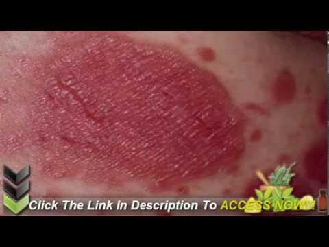 how to get rid of guttate psoriasis