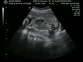19.5 haftalık gebelikte ultrasonografi
