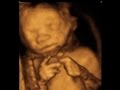 19.5 haftalık gebelikte ultrasonografi