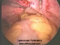 Laparoscopic Uterosacral Hysteropexy Laparoscopic Uterosacral Hysteropexy