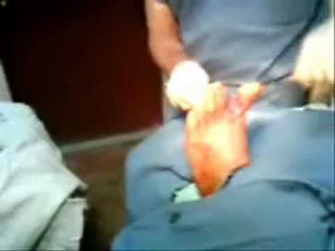 amputacion - Apreciación de una amputación de un dedo necrosado, de un pie diabético.-