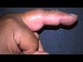 Mallet finger dedo en martillo