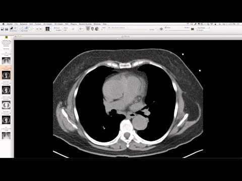 how to treat eosinophilic pneumonia