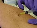 Cosmetic Radiosurgery Mole Removal