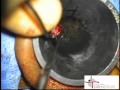 Stapedectomy, David Foyt, MD