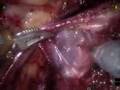 Live Webcast: da Vinci® Robotic-Assisted Prostatectomy