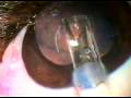 Cirurgia de Catarata em c�o com Implante de lente intra-ocular dobr�vel