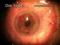 operacion de transplante corneal