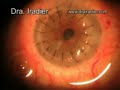 operacion de transplante corneal