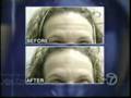 Non Surgical Facelift. No Surgery--Just Results!