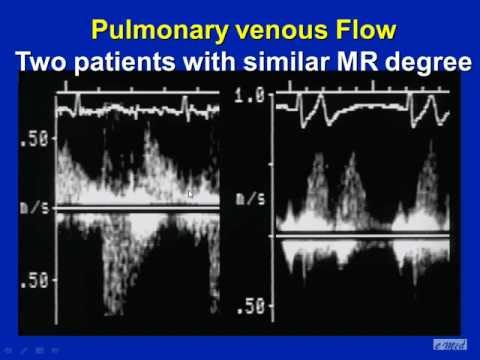 how to measure mr vena contracta