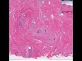 Histopathology Skin--Acne