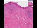 Histopathology Skin--Acne