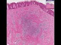 Histopathology Skin--Acne