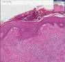 Histopathology Skin--Acne