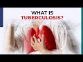 The Best 15 Tuberculosis Vaccine Arm