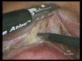 Total Laparoscopic Hysterectomy - The \"DRS\" Technique