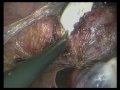 Total Laparoscopic Hysterectomy - The 