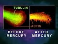 Mercury Fillings are Dangerous - Here is information