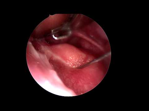 how to drain retropharyngeal abscess