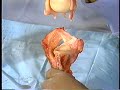 Movie 2 Suction cup