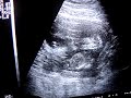Este es el primer video de nuestro hijo, grabado a las 13 semanas de vida... que será, un Martín o una Florencia..!!!??