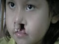 ICSF - International Children's Surgical Foundation