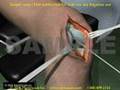 3D Medical Animation: Femur Rodding