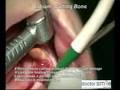 Erbium laser clinical treatment