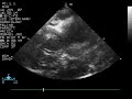 An echocardiogram from a cat with cardiomyopathy showing spontaneous contrast (